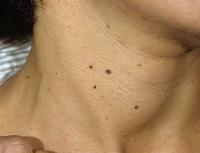 The meaning of moles on the face in men and women